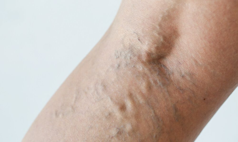 What Are Varicose Veins? Causes, Symptoms, and When to Seek Treatment