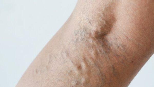 What Are Varicose Veins? Causes, Symptoms, and When to Seek Treatment