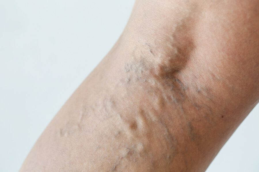 What Are Varicose Veins? Causes, Symptoms, and When to Seek Treatment
