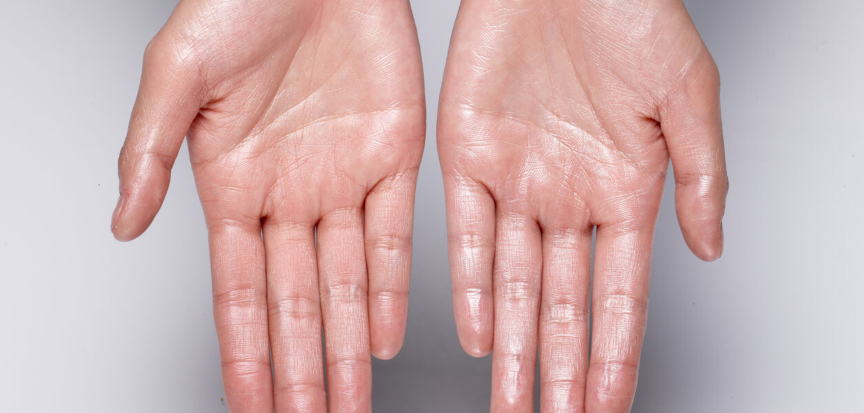 When will I grow out of this excessive sweating?