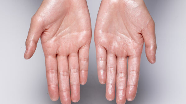 When will I grow out of this excessive sweating?