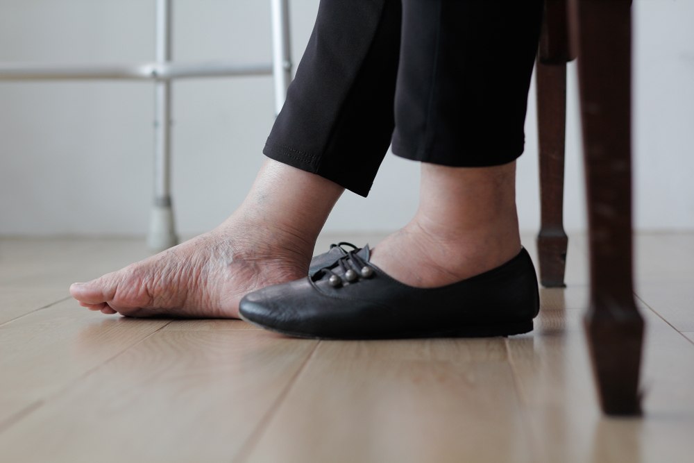 Elderly,Woman's,Feet,Show,Venous,Eczema,&,Swollen,Ankles.