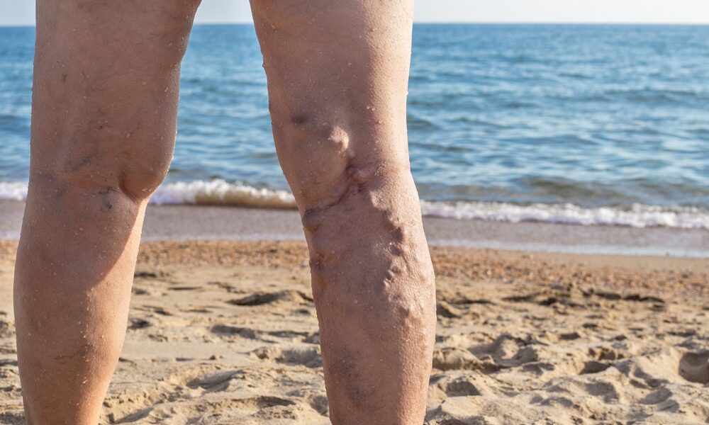 In a nutshell: useful information on your varicose veins treatment