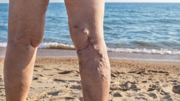 In a nutshell: useful information on your varicose veins treatment