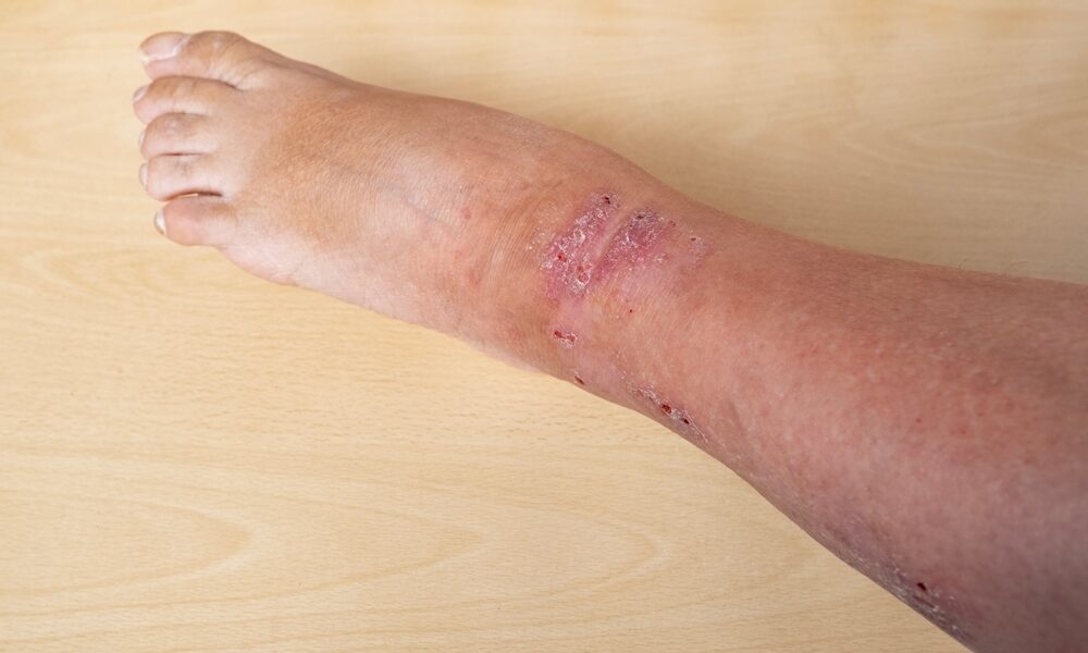 Itchy skin – may be a sign of venous eczema?