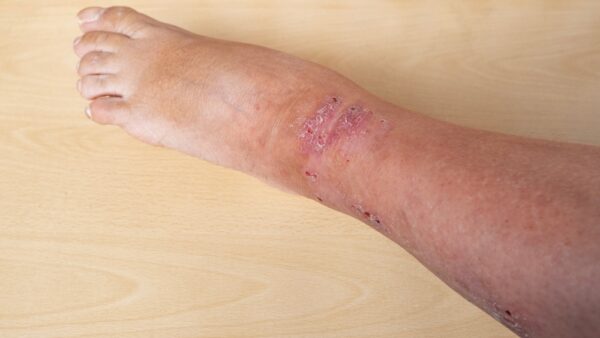 Itchy skin – may be a sign of venous eczema?