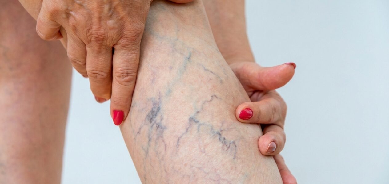 Why are spider veins appearing now I’m older?