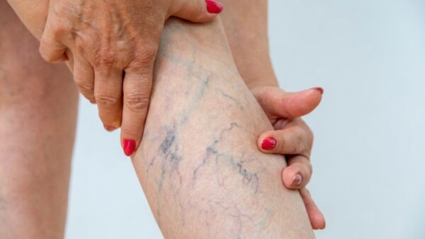 Why are spider veins appearing now I’m older?