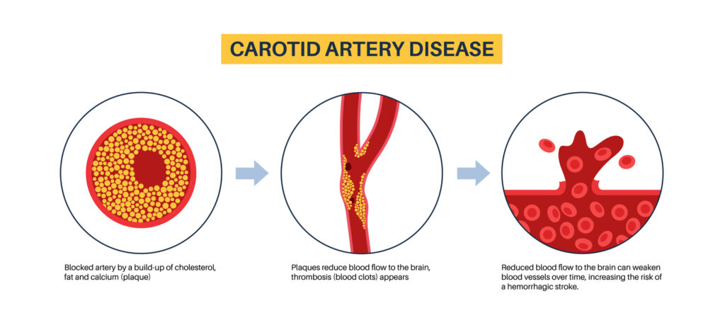 Illustration of carotid artery disease and how cholesterol blocks the artery and reduces blood flow.