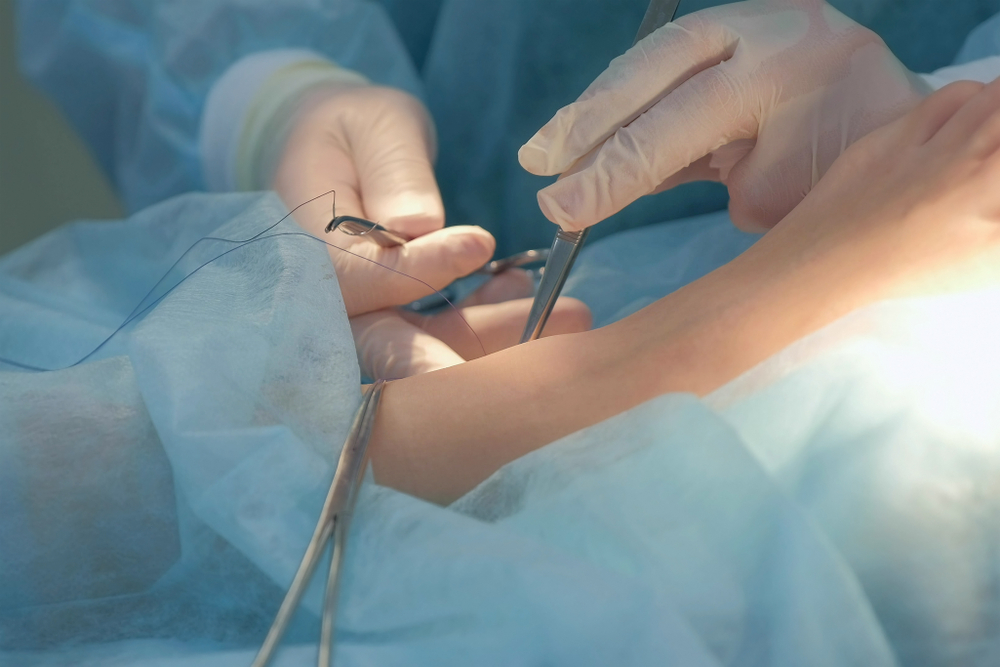 Interventional,Radiologist,Sutures,Leg,During,Vein,Treatment.