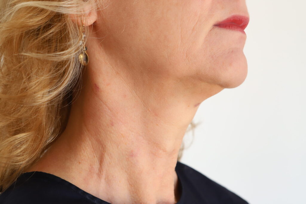 Woman's neck showing small injection spots from highly concentrated hyaluronic acid