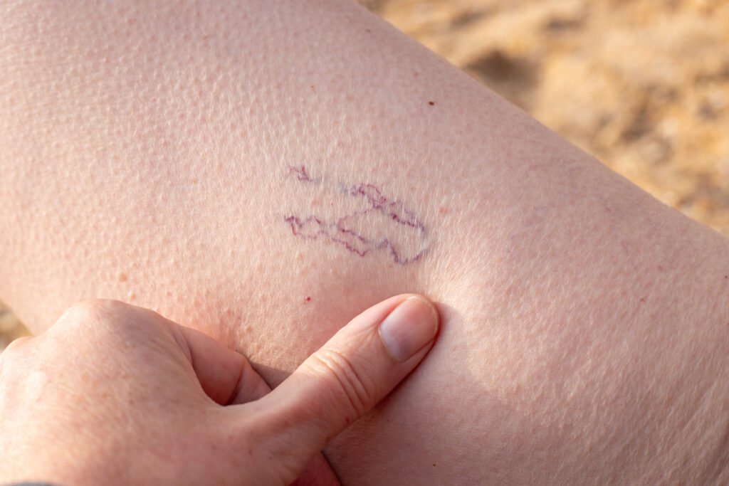 Woman pushes thumb into skin to highlight a rectangle of spider veins, varicose veins.