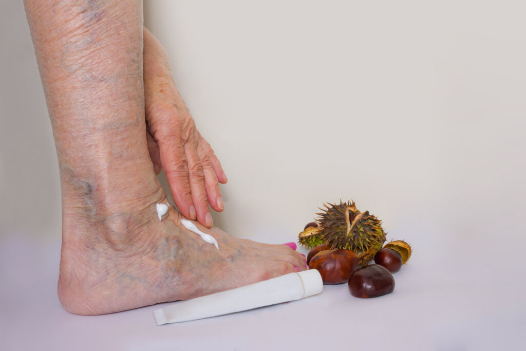 Leg and foot with varicose veins cream has been applied to the upper foot., reinforcing varicose vein myths.