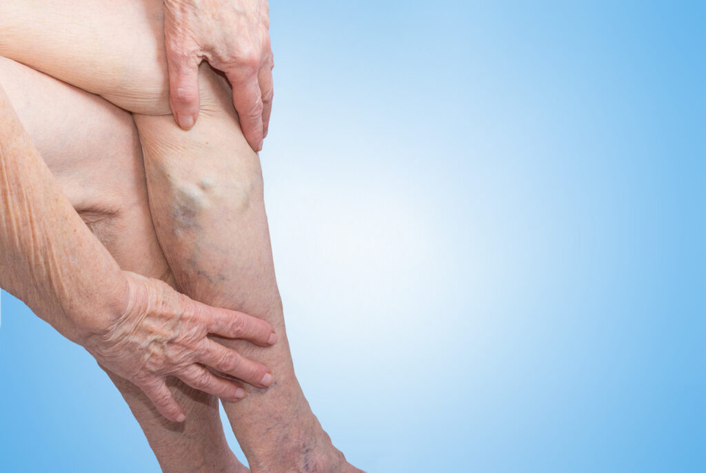 Older woman with ropey varicose veins and spider veins. Legs are crossed on blue background.