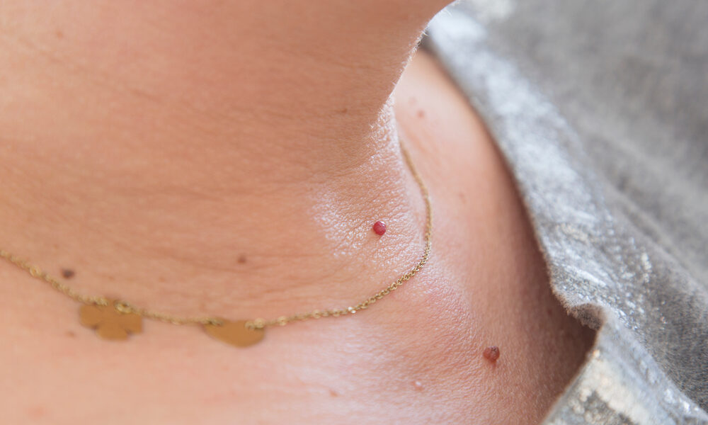 How to have your annoying skin tags removed.