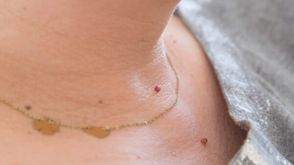 How to have your annoying skin tags removed.
