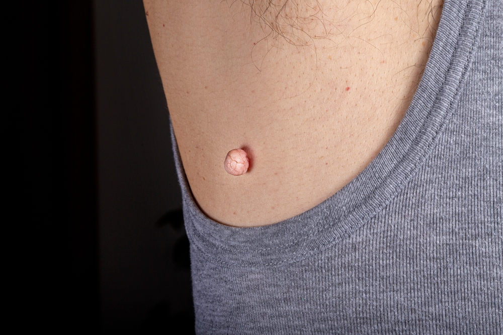 Close up of skin tag under arm, common place to have skin tags removed.
