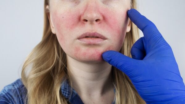 How to Reduce Facial Redness Caused by Rosacea
