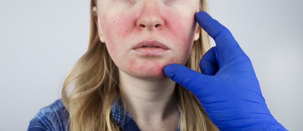 How to Reduce Facial Redness Caused by Rosacea