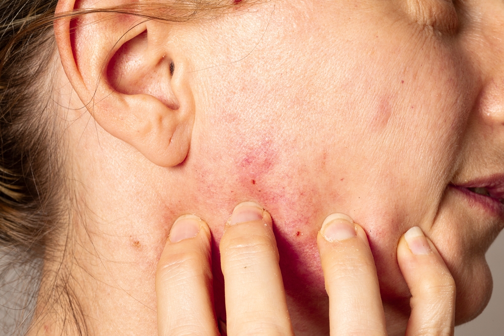 Close up of a woman's lower cheek with Rosacea.