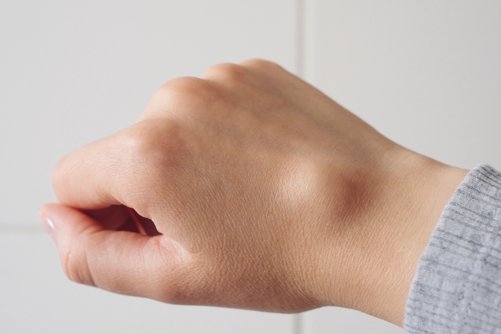 Wrist formed into a fist, gangion cyst on the crease of the wrist.