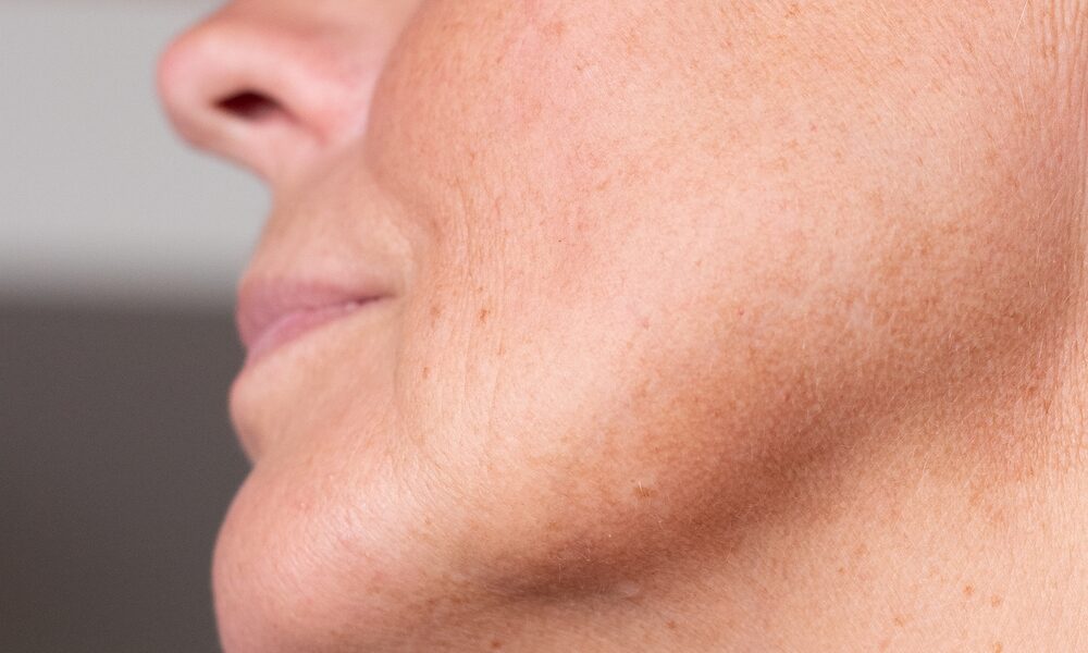 Is IPL the best treatment for my sun damage?