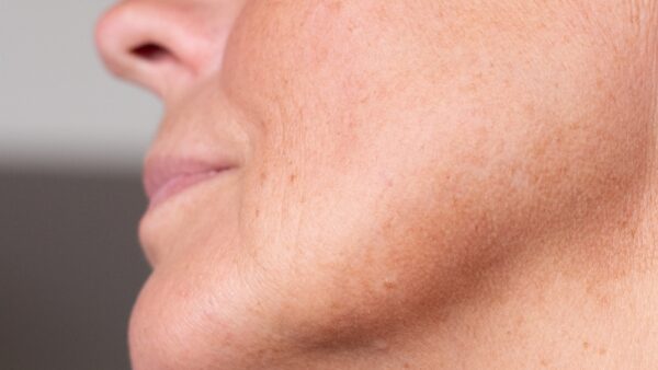 Is IPL the best treatment for my sun damage?