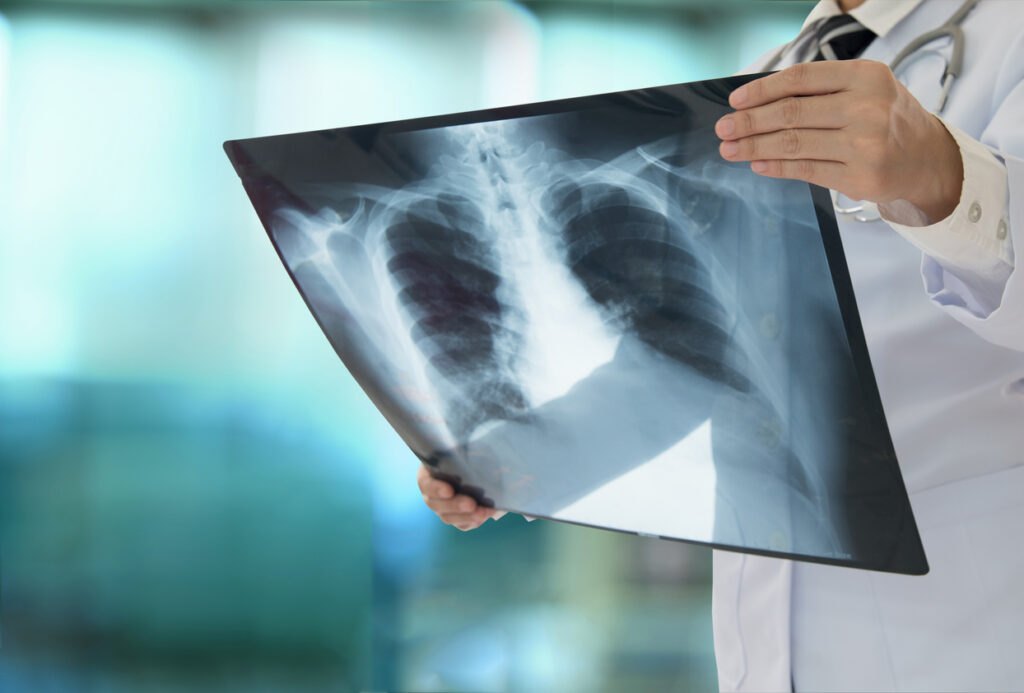 A radiologist holds up film of an X-ray of the chest.