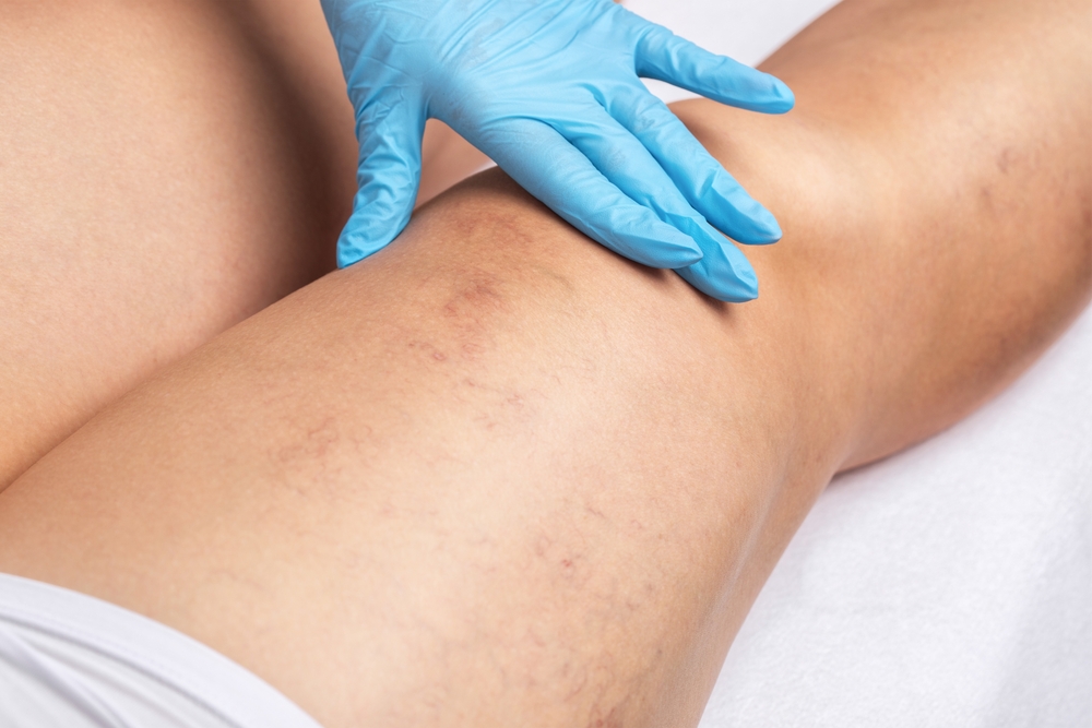 Right leg of a patient on a bed showing small varicose veins. Treatment is not painful.