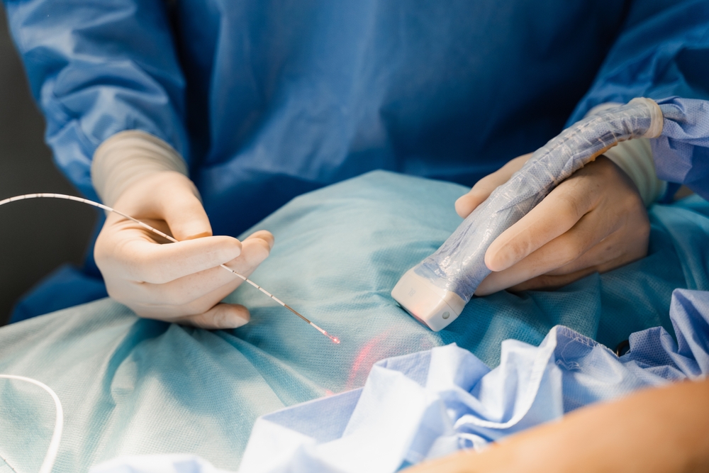 Specialist holds ultrasound wand and instrument for varicose vein procedure. The procedure is not painful for the patient.